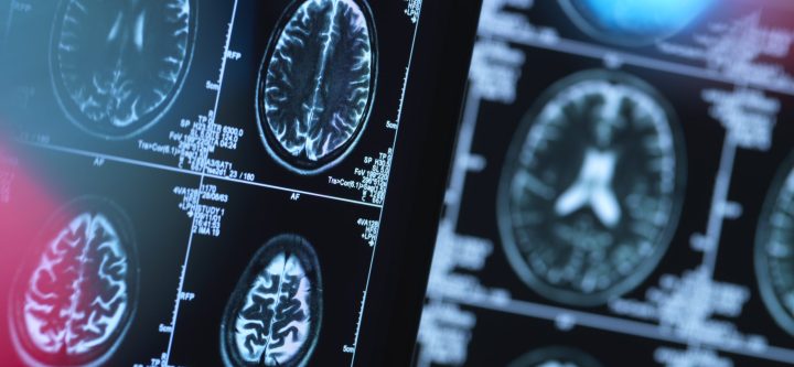 Brain scans of possible disease or damage in clinic Brain scans of possible disease or damage in clinic